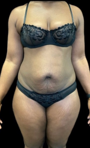 Abdominoplasty (Tummy Tuck) Before and After Pictures in Buffalo, NY
