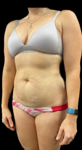 Abdominoplasty (Tummy Tuck) Before and After Pictures in Buffalo, NY