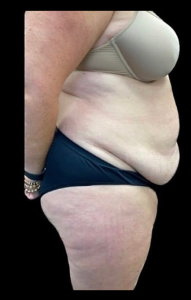 Abdominoplasty (Tummy Tuck) Before and After Pictures in Buffalo, NY