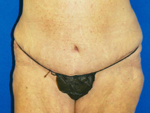 Abdominoplasty (Tummy Tuck) Before and After Pictures Buffalo, NY