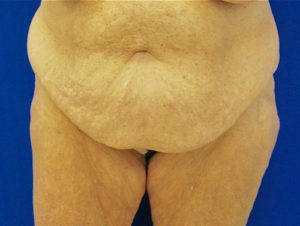 Abdominoplasty (Tummy Tuck) Before and After Pictures Buffalo, NY