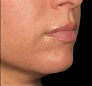 Ulthera Before and After Pictures Buffalo, NY