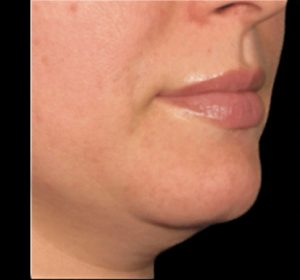 Ulthera Before and After Pictures Buffalo, NY