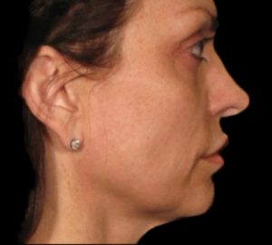 Ulthera Before and After Pictures Buffalo, NY