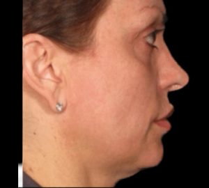 Ulthera Before and After Pictures Buffalo, NY